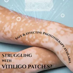 This image highlights our safe and effective phototherapy treatment for vitiligo. This therapy uses controlled light to stimulate natural skin repigmentation, offering a reliable solution for those struggling with vitiligo patches.