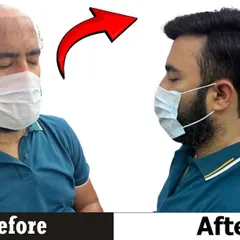 This is a perfect example of how a hair patch can completely change your side profile. Our focus is on creating a seamless blend and a sharp, stylish haircut that looks completely natural from every angle.