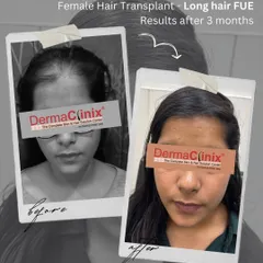 A clear before and after of a 2000 graft Long Hair FUE transplant for a female patient. The results, visible after only three months, demonstrate the effectiveness of this no shave technique for women.