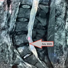 Here is the follow-up MRI after nine months of consistent, non-surgical physiotherapy. The disc has almost completely retracted, and the patient is now pain-free. This is the power of trusting the process.