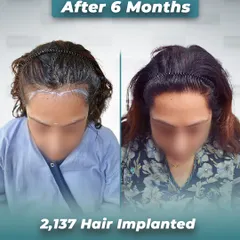 A top-down view of the same female client's 6-month progress. This angle clearly shows the increased density and coverage along her part, demonstrating the effectiveness of our specialized female hair restoration.