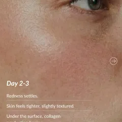 Day 2-3 after microneedling: The initial redness settles, and your skin may feel tighter and slightly textured. Beneath the surface, the crucial process of new collagen production has begun.