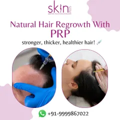 This image shows the application of PRP for natural hair regrowth. I perform this procedure for both male and female pattern hair loss, injecting platelet-rich plasma to nourish the scalp and encourage stronger, thicker hair.