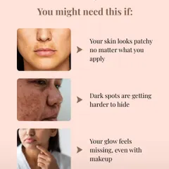 You might need this facial if your skin looks patchy or your glow is missing. These are common signs of pigmentation buildup, which OxyGeneo+ is designed to address.