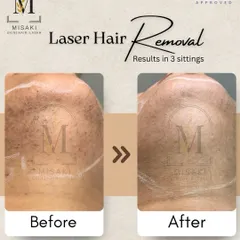 This before and after of a chin and neck treatment shows the progress after just three sittings. Notice not just the hair reduction, but the improvement in overall skin texture.