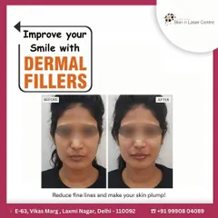 This before-and-after image shows the subtle yet impactful result of using dermal fillers. Notice how the treatment has reduced fine lines and added plumpness to the skin, creating a more youthful and refreshed smile without looking unnatural.
