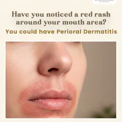 A red rash around the mouth area may not be acne; it could be Perioral Dermatitis. This inflammatory condition is common and often mistaken for other issues, requiring a specific diagnosis for effective treatment.