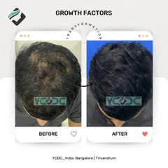 This before and after shows the power of non-surgical treatments. Using growth factors, I was able to significantly boost this patient's hair growth and volume, resulting in much better scalp coverage.