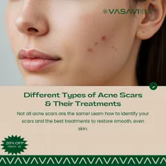 This image introduces the topic of identifying different types of acne scars. Learning how to see the difference between them is the first step toward finding the best treatments to restore smooth, even skin.