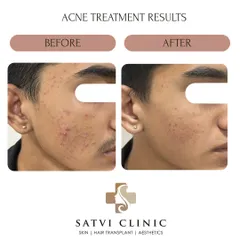 This is a clear example of how we can manage and control teenage acne. With a proper diagnosis and a consistent, simple routine, we were able to reduce active breakouts and inflammation, preventing future scarring.
