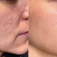 This transformation highlights the power of precision CO2 laser resurfacing. By targeting damaged skin layers, I was able to reduce the appearance of atrophic acne scars and improve overall skin texture.