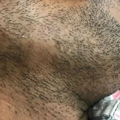 This image shows the same client's beard area after receiving treatment for Alopecia Areata. You can see the hair has started to grow back, demonstrating that with the right intervention, it is possible to manage the condition and encourage regrowth.