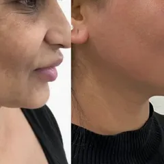 This patient presented with significant melasma on her cheeks and jawline. The after photo demonstrates the remarkable improvement achieved with my multi-modal treatment approach, combining lasers with medical management.