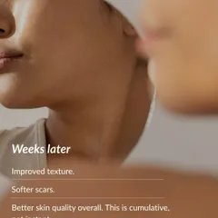 This is the result of patience and science. Weeks after a microneedling treatment, the skin's texture is visibly improved and scars are softened. We believe in educating our clients that true skin quality improvement is a cumulative process, not an instant fix.