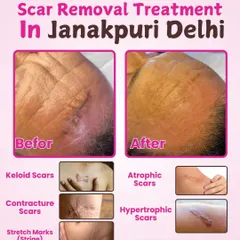 We treat a wide variety of scars, including keloid, atrophic, contracture, and hypertrophic scars, as well as stretch marks. This image shows a real before-and-after result of a scar removal treatment on the forehead.