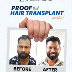 Many people are skeptical about hair transplants until they see the proof. This is Biju, whose transformation speaks for itself. Using your own hair, I restore your natural hairline with results that are designed to last, giving you back not just your hair, but your confidence.