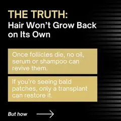 The truth is that hair will not grow back on its own once the follicles have died. No oil, serum, or shampoo can revive them. If you are seeing bald patches, only a transplant can restore hair to that area.