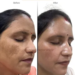 Another angle of the same melasma treatment, highlighting the clearance of pigmentation on the cheek and forehead area for a smoother, more uniform skin tone.
