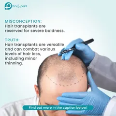We're debunking a common misconception about hair transplants. This procedure is not just for severe baldness; it's a versatile solution for various levels of hair loss, including minor thinning.