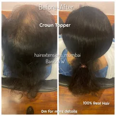 Another successful crown topper application. The topper provides natural-looking volume and coverage, completely concealing the thinning area.