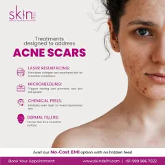 An informational graphic detailing my treatments designed to address acne scars. It lists Laser Resurfacing, Microneedling, Chemical Peels, and Dermal Fillers as key solutions for a smoother complexion.