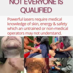 Not everyone is qualified to operate a powerful laser. These machines require deep medical knowledge of skin anatomy, energy settings, and safety protocols. The images here show the unfortunate results when non-medical operators attempt these procedures.