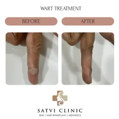 This is a successful wart treatment on a finger, achieved without surgery. I used a safe and effective intralesional MMR injection, an immunotherapy technique that stimulates the body's own immune system to clear the wart with a low risk of scarring.