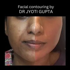 A split-face view demonstrating the power of facial contouring. The right side shows the immediate post-procedure result, with enhanced volume and a smoother contour compared to the untreated left side.