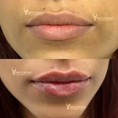 This is a great example of how lip fillers can enhance your natural beauty. We added subtle volume and definition to create a balanced, hydrated, and youthful pout. The goal is always to refine, not to change your look entirely.