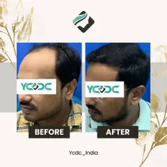 A side-view comparison of a hair transplant result. Notice the restored hairline and increased thickness, which frames the face and creates a more youthful appearance.
