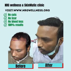 The core benefits of our FUE procedure are clear: no cuts, no linear scars, and minimal blood loss. We are committed to delivering 100% natural-looking results with a focus on your safety and comfort.