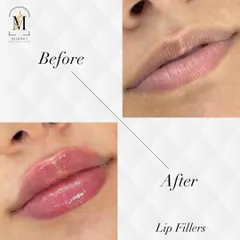 Here is a beautiful example of my lip filler work. I focus on enhancing the natural shape and restoring volume for a hydrated, balanced look, avoiding the overfilled or "duck" look.
