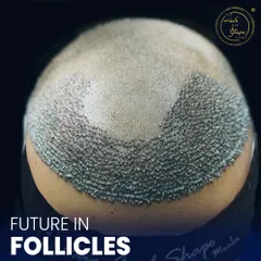 This image highlights the coverage achieved in a single session. We focus on creating a dense pack of follicles that will grow into a strong, healthy head of hair, permanently solving issues of balding or thinning in the transplant area.