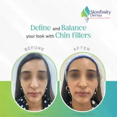 A well-defined chin brings balance to the entire face. This before and after demonstrates how chin fillers can create a stronger, more harmonious facial profile without surgery.