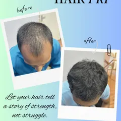 This before and after image shows the significant improvement in hair density following a course of Platelet-Rich Plasma (PRP) therapy. This non-surgical treatment uses the healing power of your own blood to reactivate dormant hair follicles, making it an effective solution for early-stage hair thinning and androgenetic alopecia.