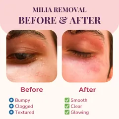 This before and after comparison shows the result of our milia removal service. We transform bumpy, textured skin around the eye into a smooth, clear, and glowing surface by safely extracting the tiny cysts.
