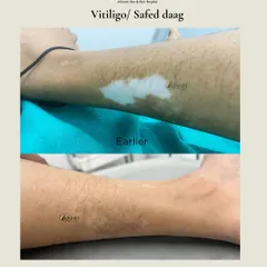A before-and-after view of vitiligo treatment on a patient's arm after three months. The combination of medication and surgery has led to significant repigmentation, blending the white patch with the surrounding skin.