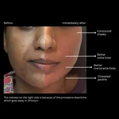 This is a great example of what's possible with a personalized facial contouring plan. You can see how we achieved more contoured cheeks, softened smile lines, and a chiseled jawline. The temporary redness you see fades within 24 hours.