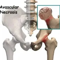 Avascular Necrosis (AVN) is a condition where bone tissue dies due to a lack of blood supply. Physiotherapy plays a crucial role in managing pain, improving mobility, and helping with recovery.
