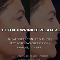 This before and after demonstrates how a wrinkle relaxer like Botox works. It is excellent for softening movement lines like frown lines and crow's feet. However, aging involves more than just these lines, which is why a combination approach is often best.