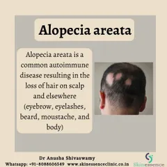 This graphic defines alopecia areata, an autoimmune condition where the body's immune system attacks hair follicles, resulting in distinct, often circular, patches of hair loss on the scalp or other parts of the body.