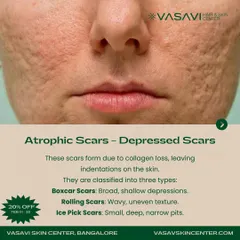 Atrophic scars, or depressed scars, form due to a loss of collagen during the healing process. This image shows a close-up of this scar type and further classifies them into boxcar, rolling, and ice pick scars, each with a unique shape and depth.