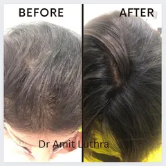 This before and after demonstrates a significant improvement in hair density and volume. My hair restoration treatments are designed to combat thinning and stimulate new growth for fuller, healthier hair.