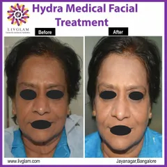 The 'after' photo shows the powerful effects of a Hydra Medical Facial on mature skin. The treatment improved hydration, reduced the appearance of fine lines, and gave the skin a healthier, more luminous quality.