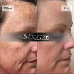 A powerful before and after image showcasing the results of our pigmentation treatment. We effectively reduced dark spots and uneven skin tone, revealing a clearer and more uniform complexion.