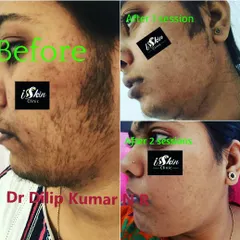 This series demonstrates the effectiveness of our laser hair reduction for the face. You can see the progressive results, from the initial state to significant hair removal after just one and then two sessions, leading to much smoother skin.