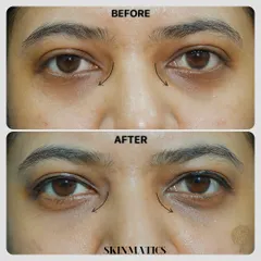 Tired-looking eyes are a common concern. Here, we used under-eye fillers to correct hollowness in the tear trough area, resulting in a smoother, brighter, and more rested appearance.