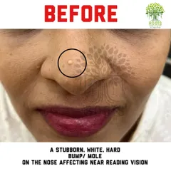 A "before" photo of another client who had a stubborn, hard white mole on her nose that even laser treatment couldn't permanently remove.