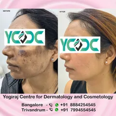 Another successful pigmentation correction case. We focus on not just clearing the marks but also strengthening the skin barrier to prevent future issues, ensuring a lasting, healthy result.