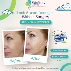 Our exclusive monsoon offer lets you look 5 years younger without surgery. This graphic details our HIFU + Fillers package, showing a powerful before-and-after result.